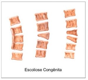 Coluna da criança