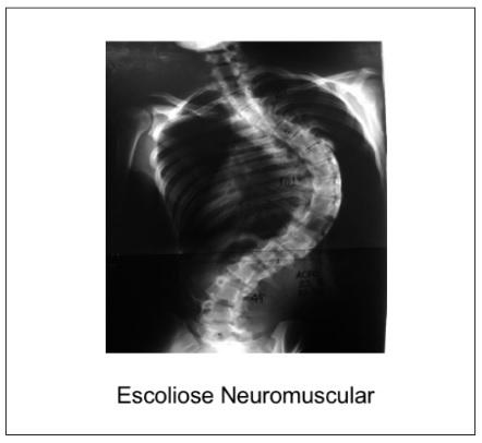 Coluna na criança - Coluna pediátrica