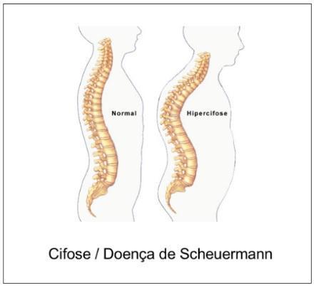 Coluna na criança - Coluna pediátrica