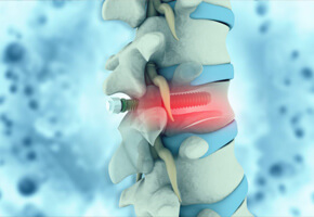 cirurgia coluna novas técnicas