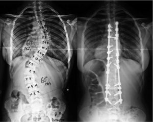 cirurgia escoliose