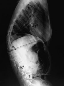 escoliose neuromuscular