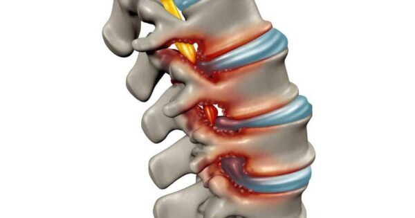 estenose do canal vertebral