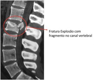 fratura na coluna 4