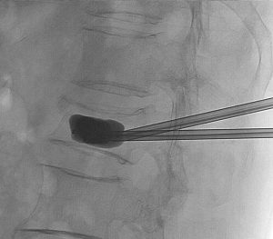 fratura na coluna cifoplastia