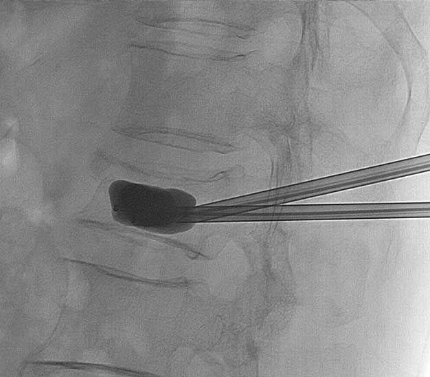 fratura na coluna cifoplastia