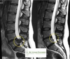 Hérnia do esporte: causas, sintomas e tratamentos - Hernia Clinic