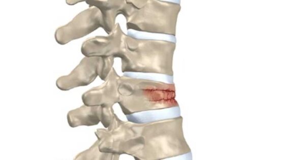 osteoporose na coluna