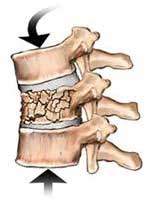 osteoporose na coluna