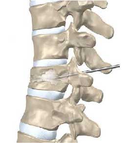 osteoporose na coluna