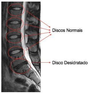 Protrusão e Abaulamento Discal