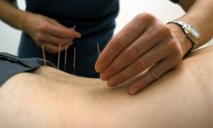 acupuntura e hérnia de disco