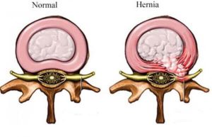 hérnia de disco pode voltar