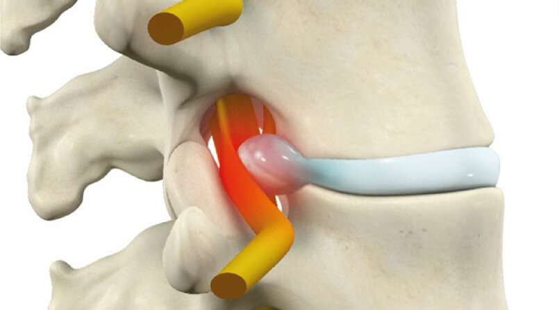 Tratamento e mudança de hábito na Hérnia de Disco