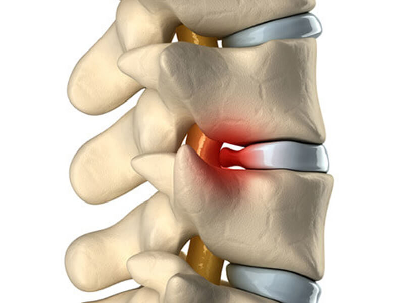 Hérnia de disco - Novos tratamentos, o que é, causas e sintomas