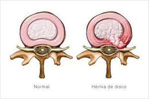 Hérnia de Disco Foraminal e Seu Impacto na Coluna Vertebral