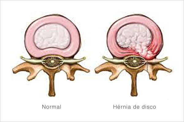 4 Dicas de Exercícios Para Hérnia de Disco Lombar