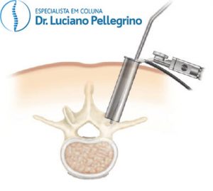 cirurgia da coluna vertebral