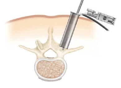 cirurgia da coluna vertebral