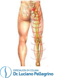 lombociatalgia