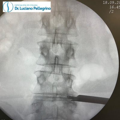 radioscopia na coluna