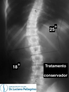 escoliose tratamento conservador