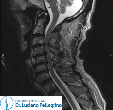 raio-x estenose do canal vertebral