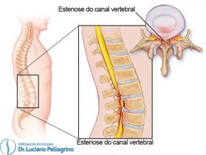 anatomia estenose do canal vertebral