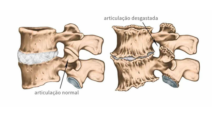 artrose na coluna tem cura