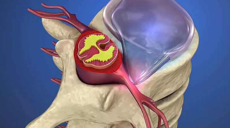 Tratamento de hérnia de disco sem cirurgia - Dr. Luciano Pellegrino