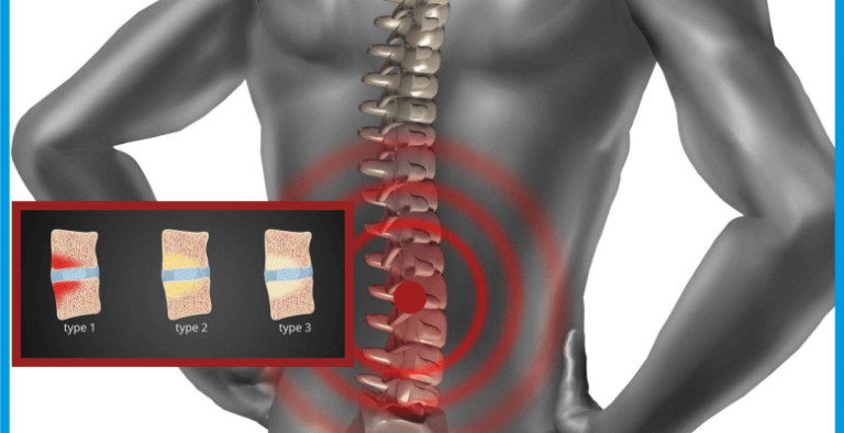 Alterações Degenerativas Tipo Modic I - Dr. Luciano Pellegrino