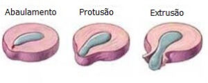 extrusão discal