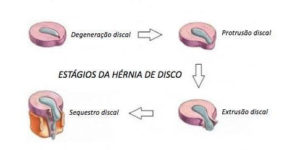 extrusão discal