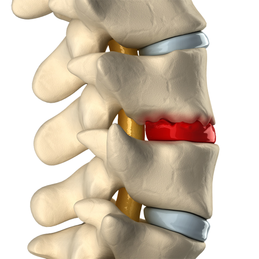 Discos vertebrais