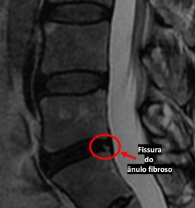 fissura do ânulo fibroso
