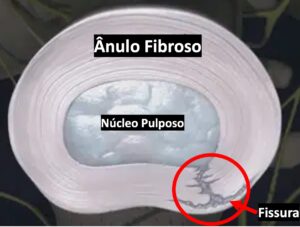 fissura do ânulo fibroso