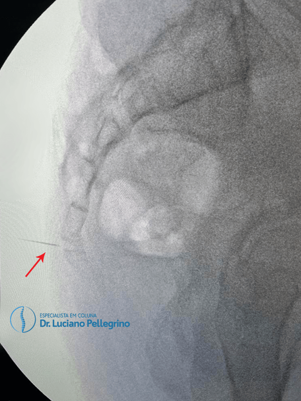 infiltração no cóccix