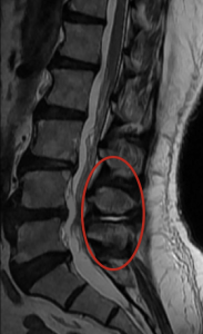 Tratamento para Edema nos Ligamentos Interespinhosos