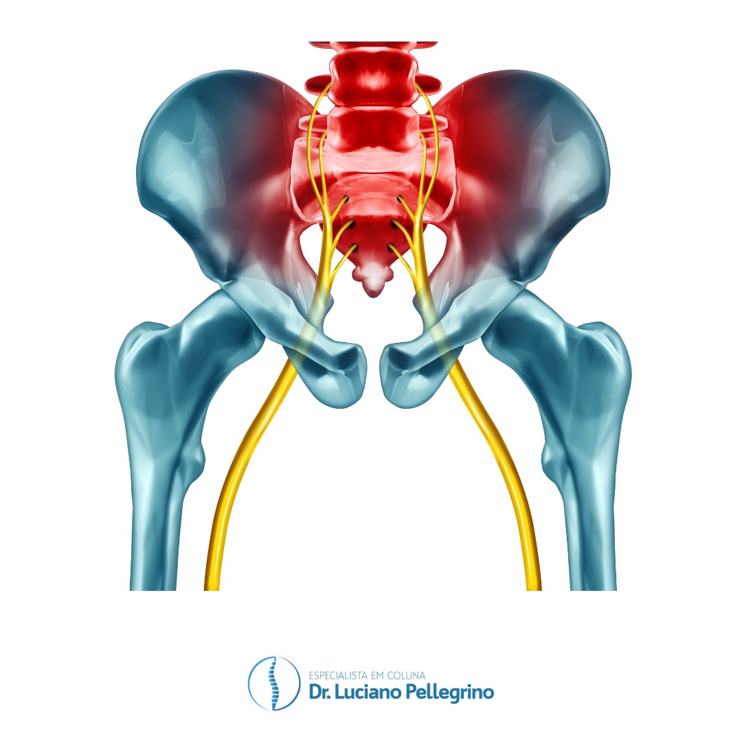 Qual exame para diagnosticar o nervo ciático inflamado?