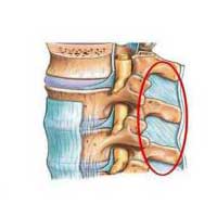 Edema nos ligamentos interespinhosos