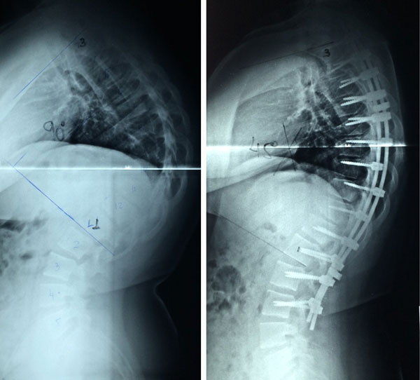 cirurgia de cifose 1