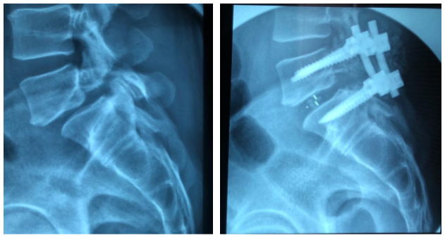 Cirurgia de espondilolistese: antes e depois