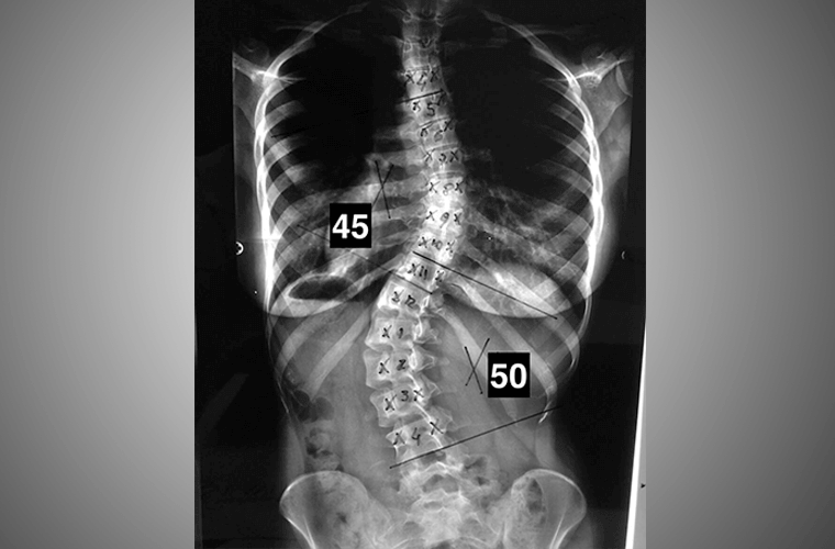 Escoliose na Infância e Adolescência