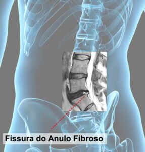 fissura do ânulo fibroso imagem em exame