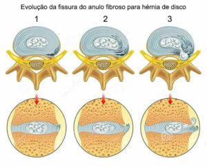 fissura do ânulo fibroso evolução