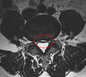 fissura do ânulo fibroso imagem de ressonância magnética vista de cima