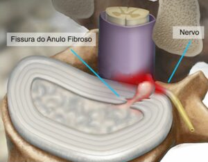 compressão do nervo pela fissura do ânulo fibroso, causando dor 