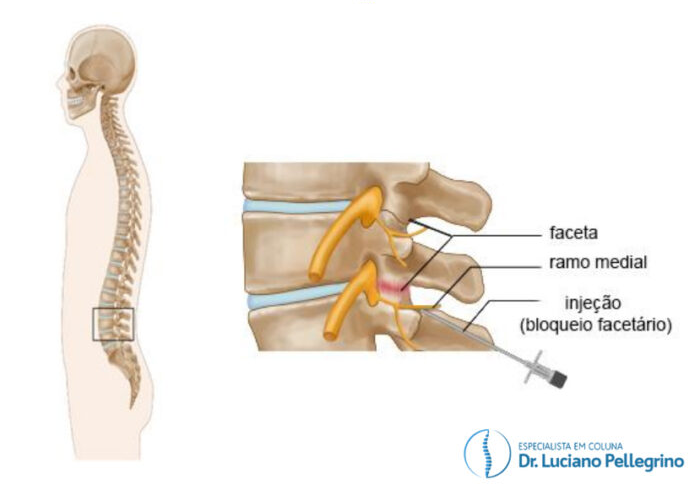 Bloqueio facetário para aliviar a dor na coluna