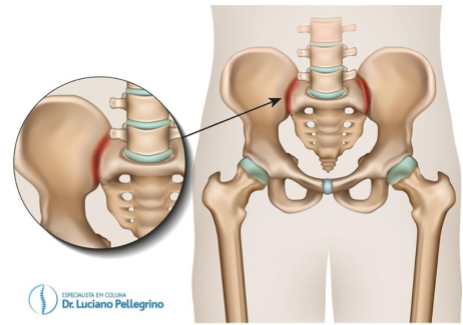 inflamação nas articulações sacroilíacas