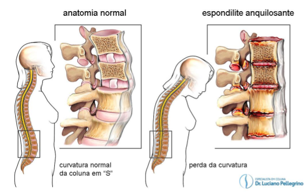 perda da curvatura normal da coluna em "S"